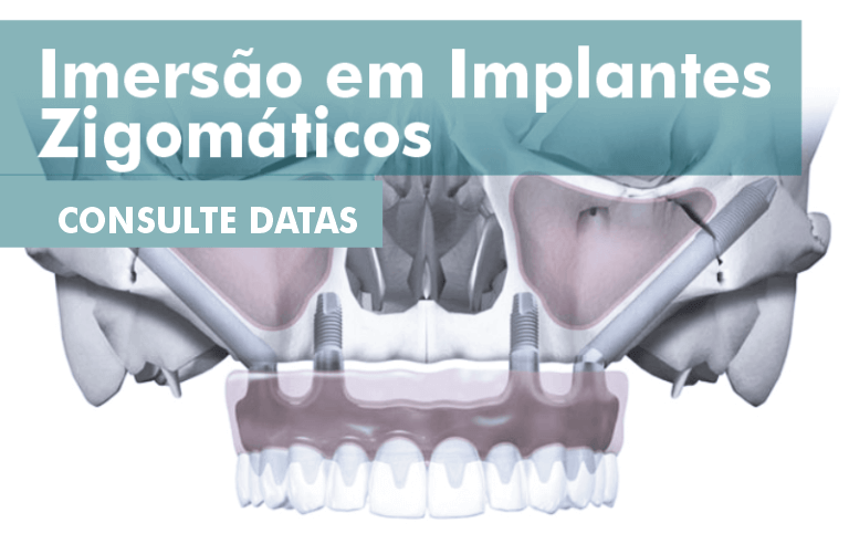 imersao implantes zigmaticos