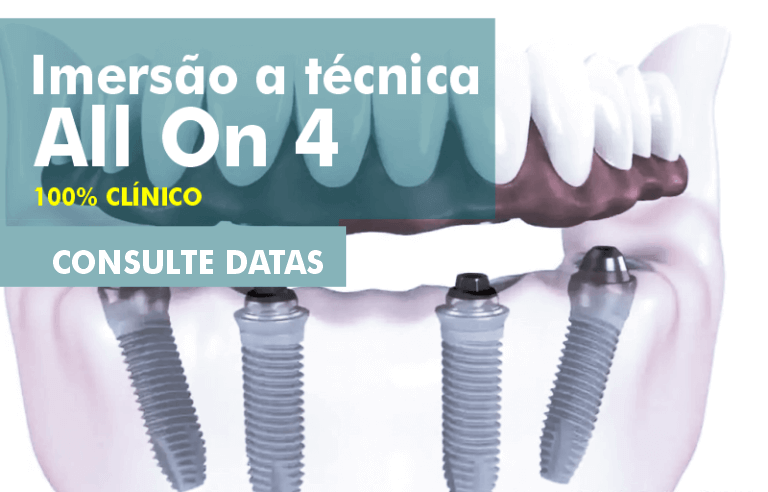 imersao tecnica All On 4 clinico